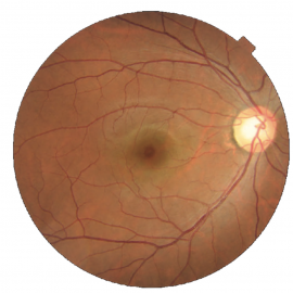 Normal retina